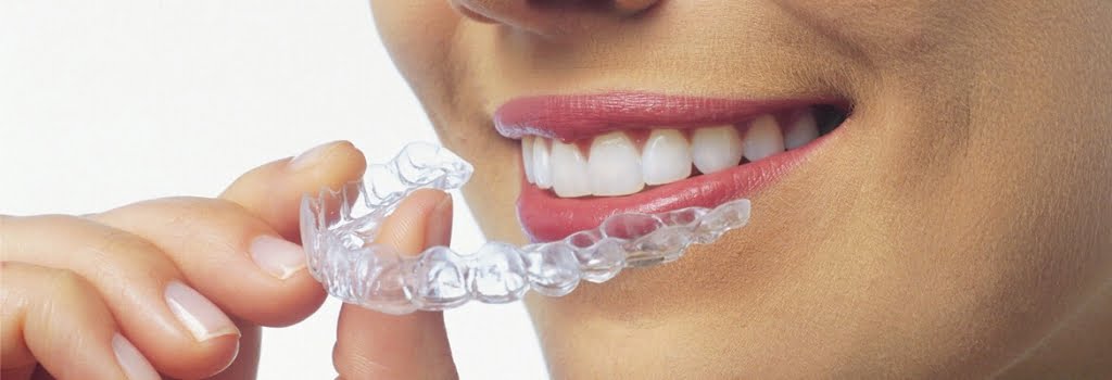 women putting on Invisalign clear aligners