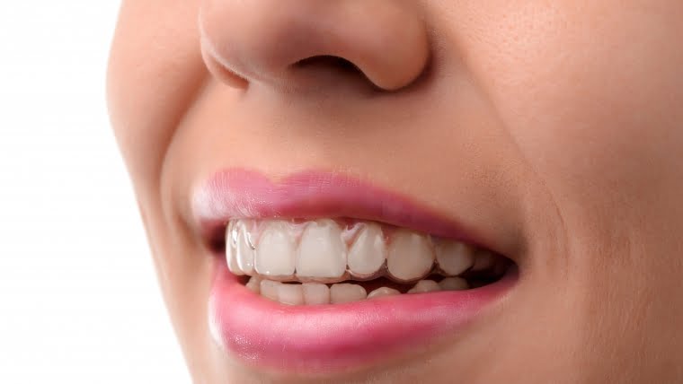 About Invisalign Part 2